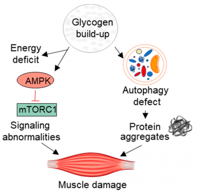 New Treatment Developments for Pompe Disease